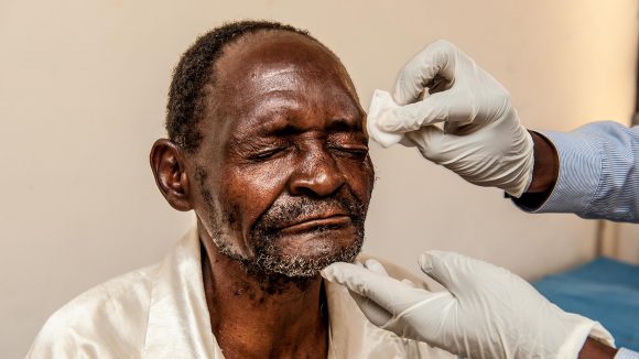 Winesi bandage removal.