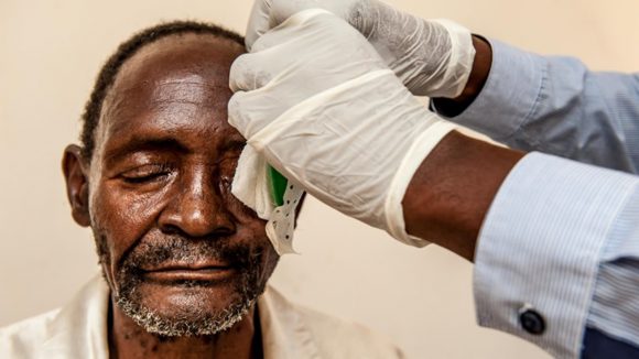 Adult cataract operation after care