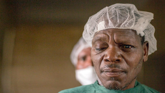 A patient in a surgical gown and cap, with a visible cataract in his left eye.