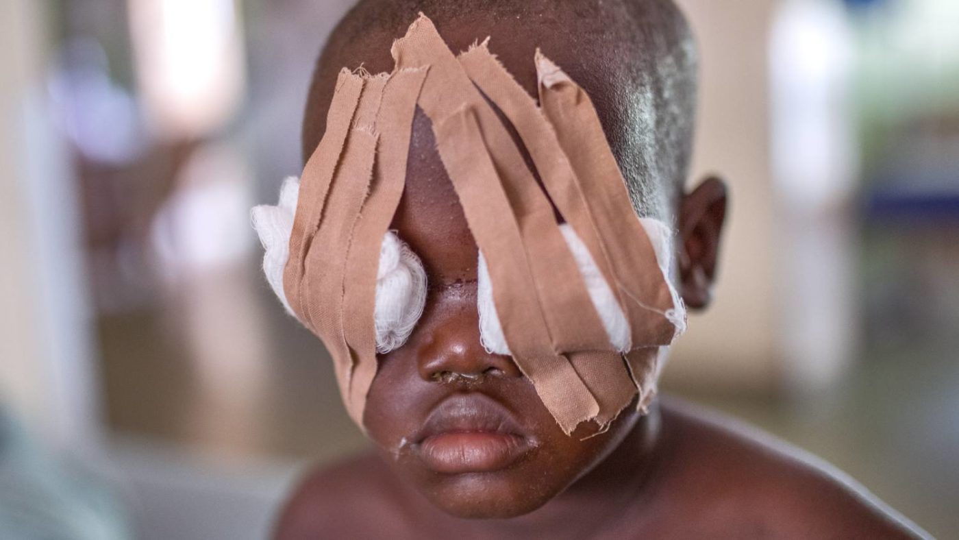 Muzi with dressings over his eyes after his operation.