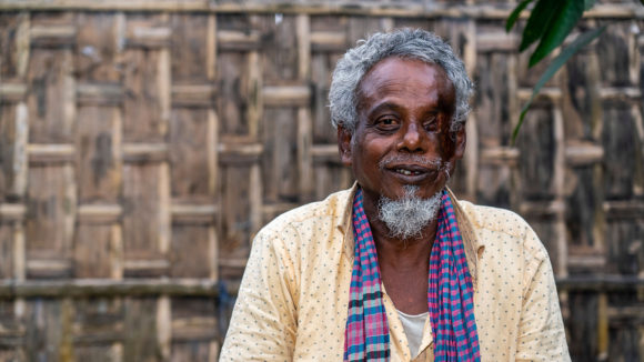 A man with a physical disability sits outside.