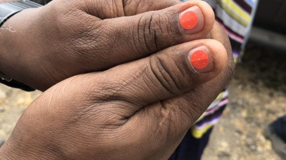 Small round red stickers with white dots help diagnose trachoma by showing what trachoma follicles would look like if present.