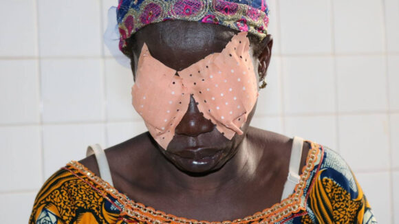 Virginie wearing bandages over her eyes after surgery.