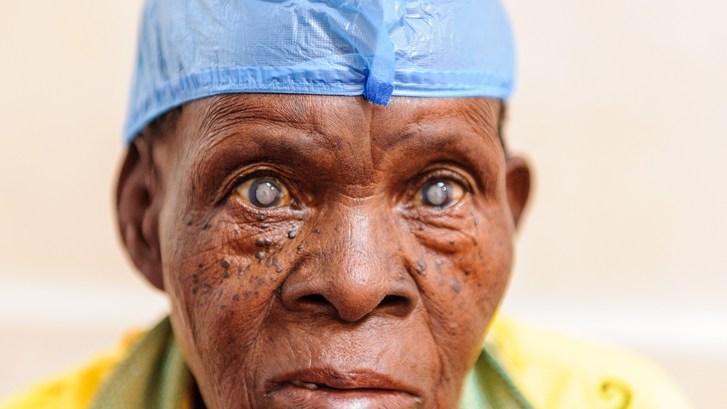 Cataracts causes symptoms and treatment sightsavers