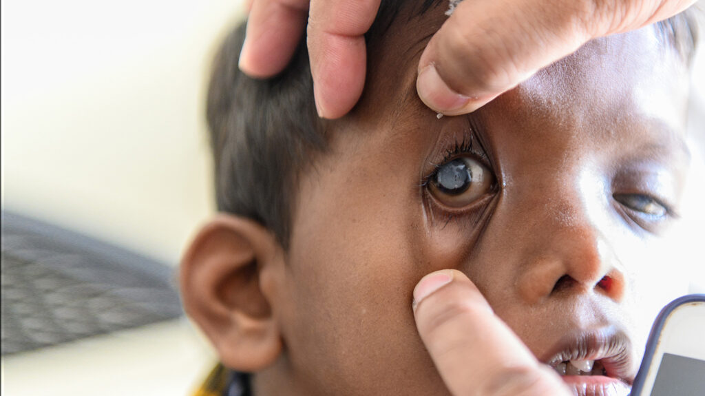 A close-up of Sanjit's eye being held open by a doctor: the surface of his eye is cloudy.